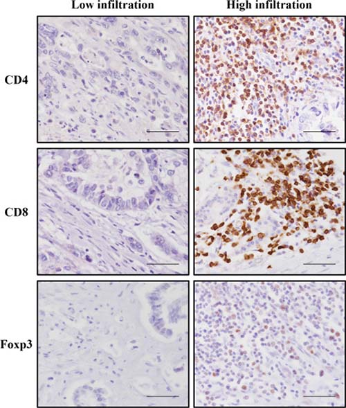 Representative immunohistochemical staining of CD4, CD8, and Foxp3 T lymphocytes that had infiltrated into the invasive front of tumor cells.