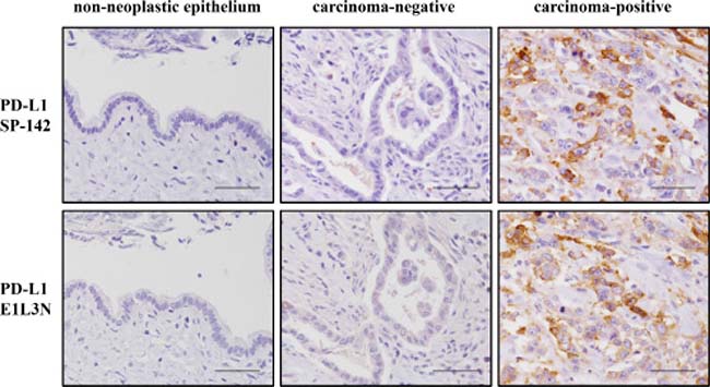 Representative images for immunohistochemical staining of PD-L1 using SP142 (top row) and E1L3N (bottom row) antibodies.