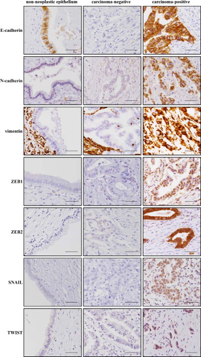 Representative images of immunohistochemical staining for EMT-related proteins E-cadherin, N-cadherin, vimentin, ZEB1, ZEB2, SNAIL and TWIST.