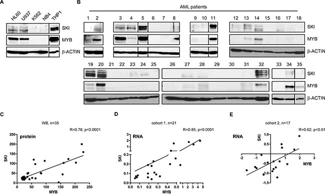 MYB and SKI expression highly correlate in AML cell lines and primary hematopoietic cells of AML patients.