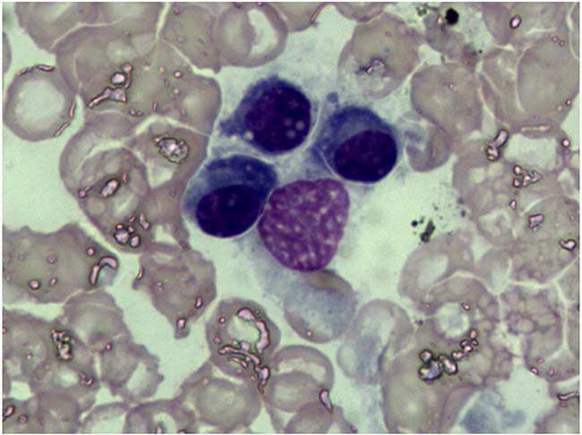 Bone marrow cytology examination.