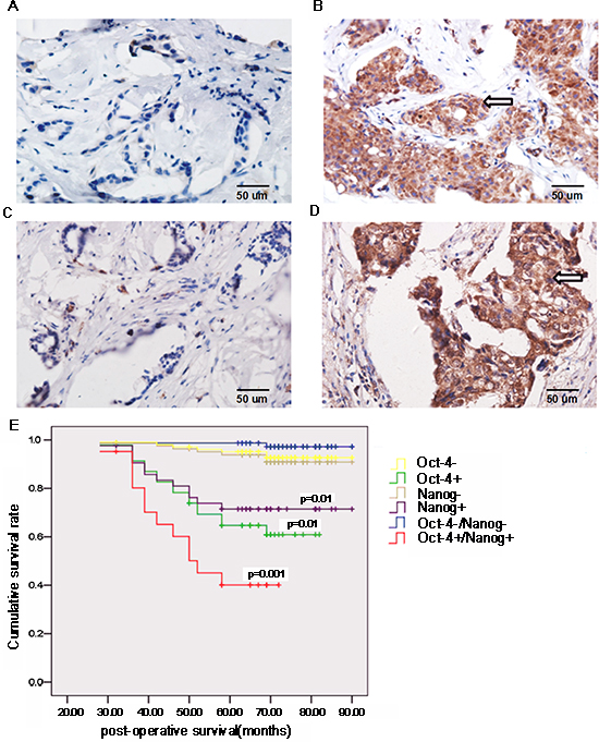 Oct-4 and Nanog expression is associated with the prognosis of breast cancer patients.