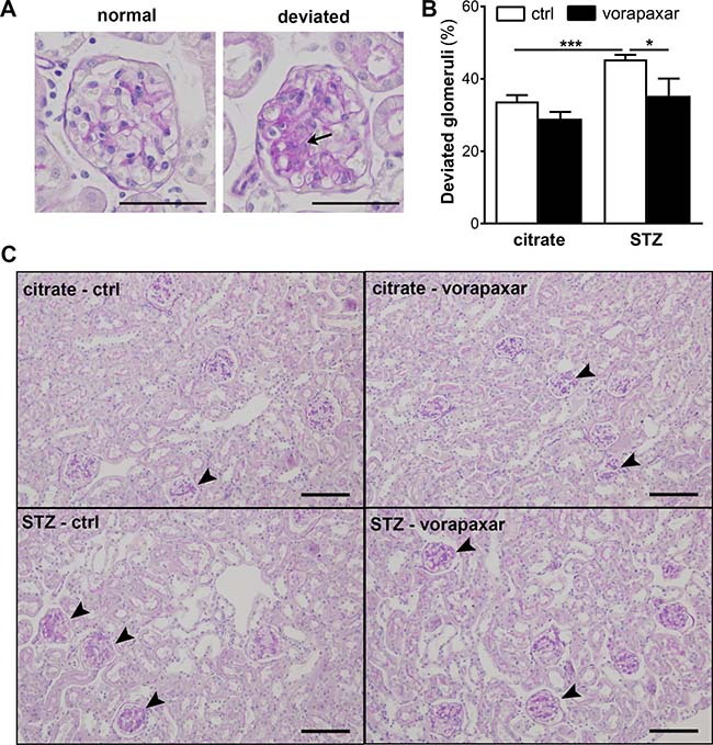 Limited mesangial expansion upon vorapaxar treatment in STZ-induced diabetic mice.
