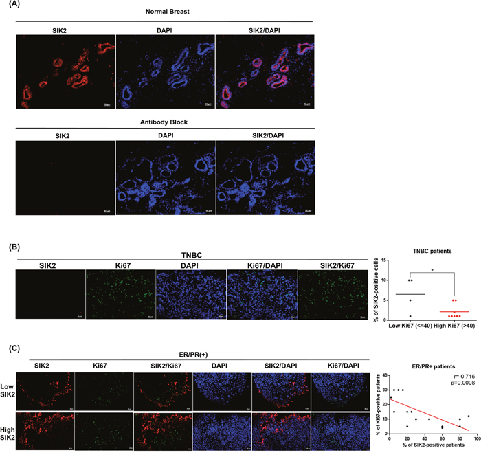 SIK2 protein expression is frequently downregulated in breast tumors and negatively correlated with mitotic activity of the breast cells.