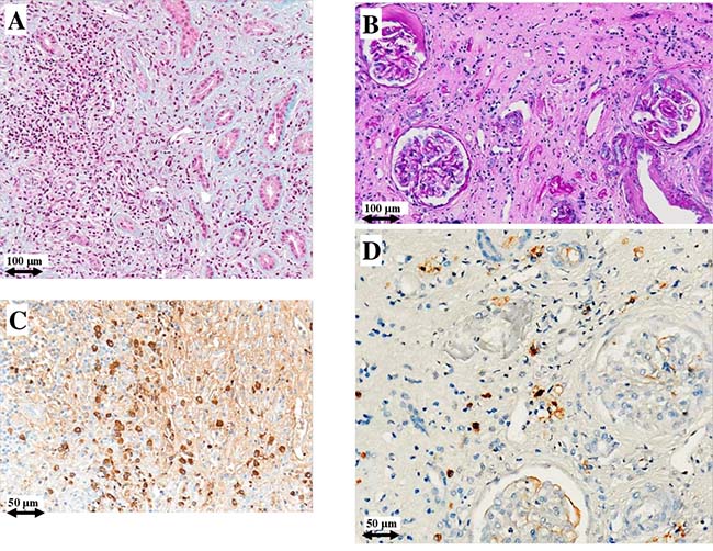 Light microscopy and immunohistochemistry findings in patient #1.