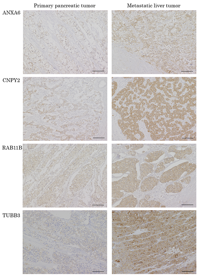 Representative pictures of IHC for the candidate proteins in PT and paired LT.