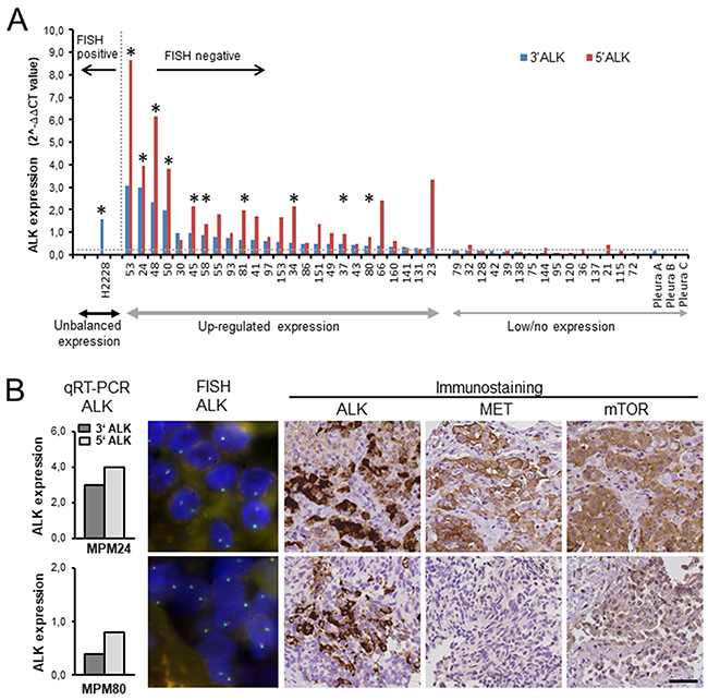 Expression of ALK, MET and mTOR in mesothelioma tumor tissue samples.