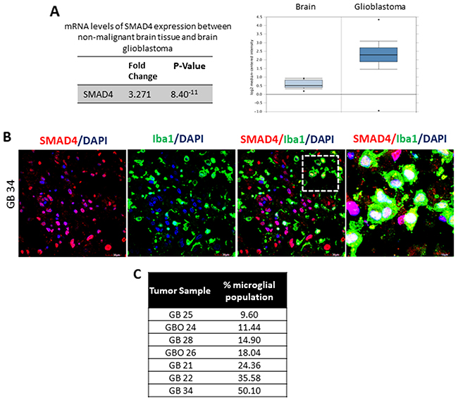 SMAD4 is expressed in microglia associated with human glioblastoma samples.