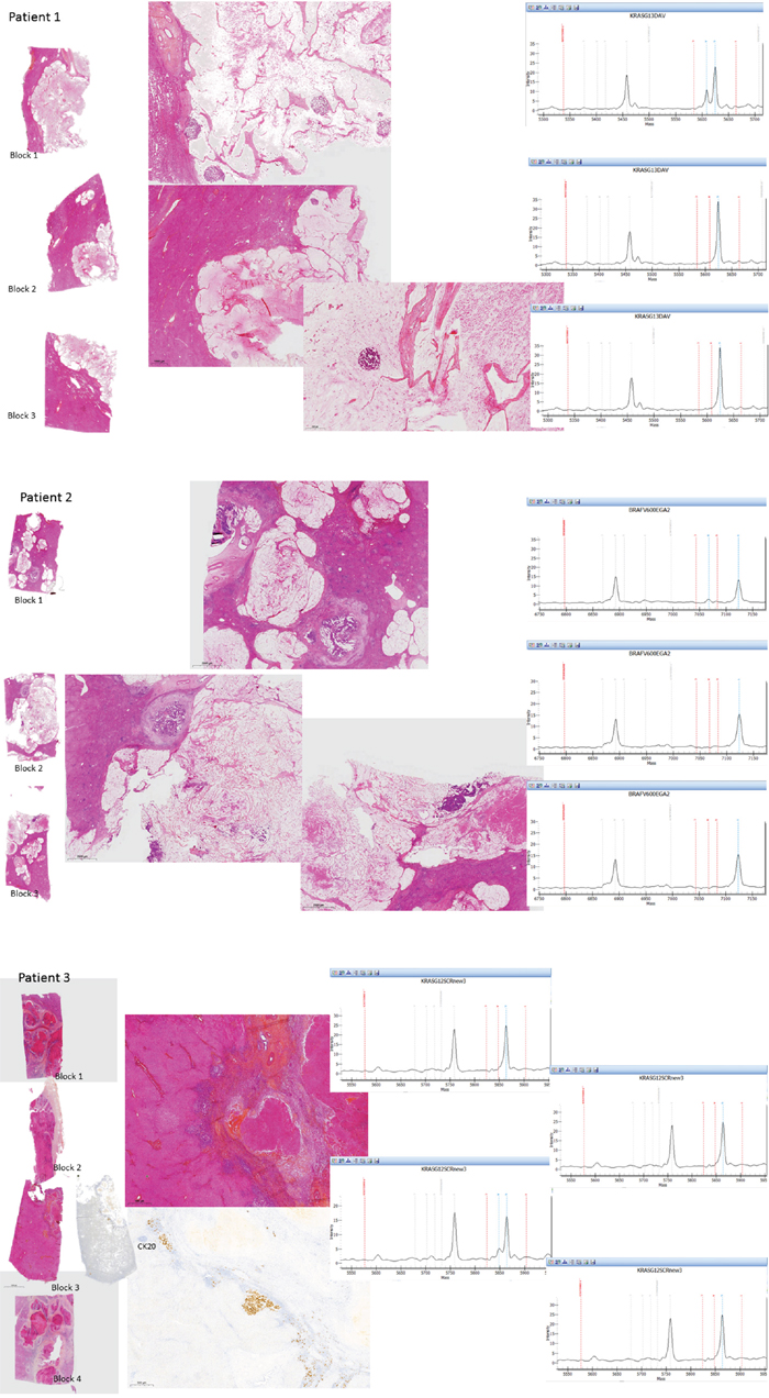 Histopathological examination of the H&#x0026;E-stained sections for each tumor area sampled and the corresponding molecular data in the 3 CLM with genetic heterogeneity.