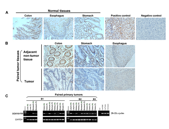 SOX10 expression is significantly decreased in tumor tissues.