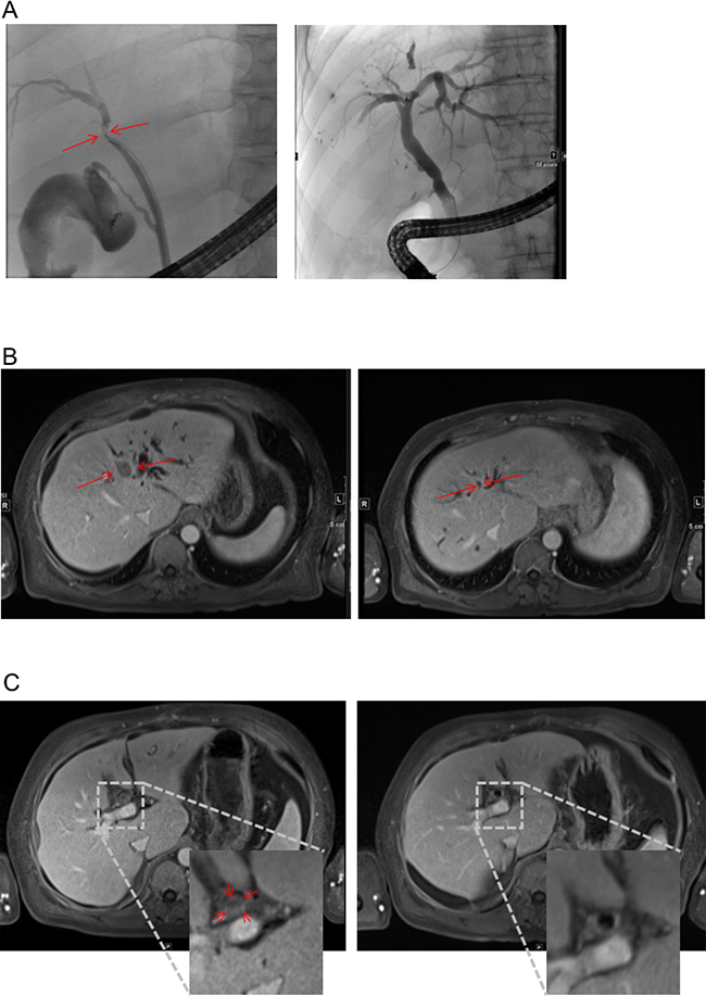 Response to therapy in MRI and ERC.