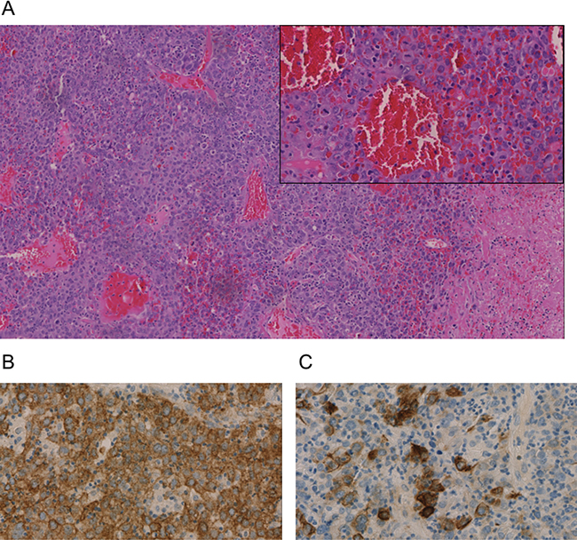 Immunohistochemistry of an undifferentiated carcinoma in Klatskin-position.