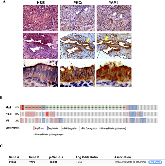 PKC&#x03B9; and YAP1 are concurrently upregulated in PDAC tissues.