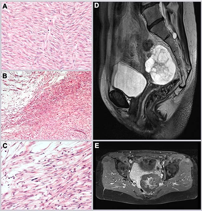 Лейомиосаркома мягких тканей фото Лейомиосаркома мягких тканей фото