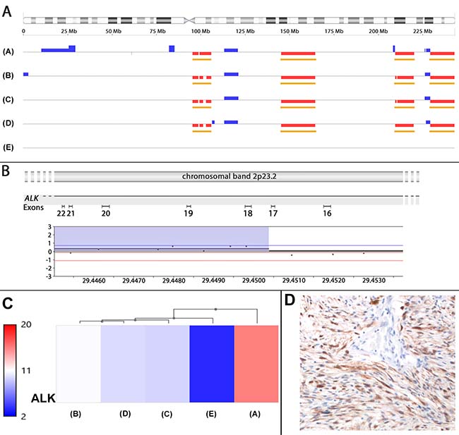 ALK amplification and rearrangement in the leiomyosarcoma.