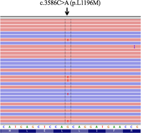 Sequence trace for cDNA encoding the L1196M mutation of the ALK kinase domain that was derived from the NSCLC of the patient.