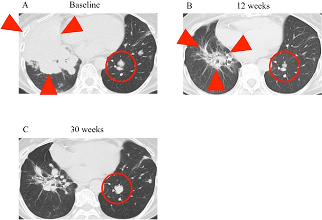 CT findings for the lung lesions of the patient during ceritinib treatment.
