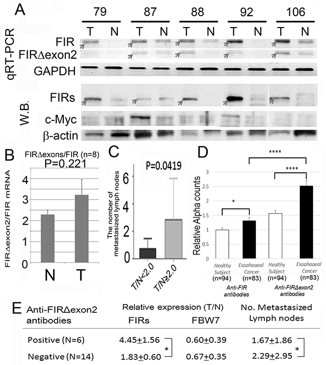 Alternatively spliced form of FIR (FIR&#x0394;exon2) was expressed in ESCC tissues and anti-FIR&#x0394;exon2 autoantibodies were detected in the serum of the patients.