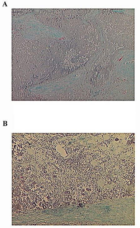 Fig.2: Mononuclear Inflammatory Infiltrates After p62 Vaccination.