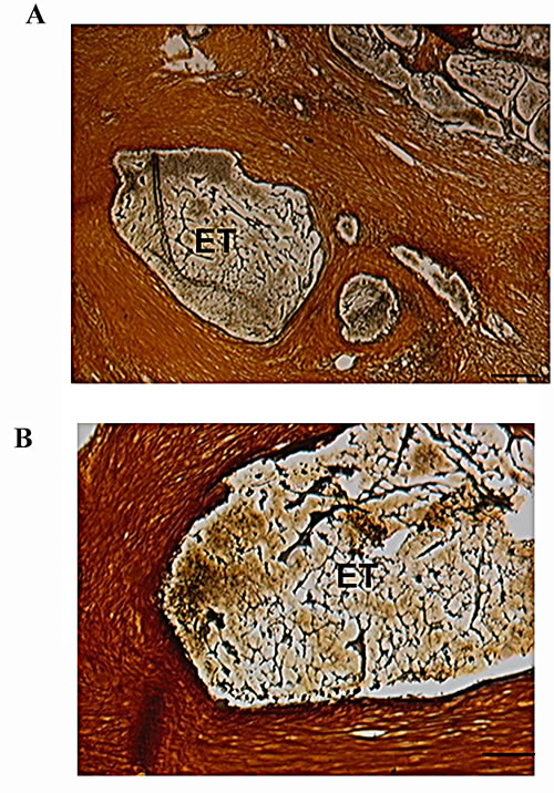 Fig.4: Tumor Islands Surrounded by Stroma After p62 Vaccination.