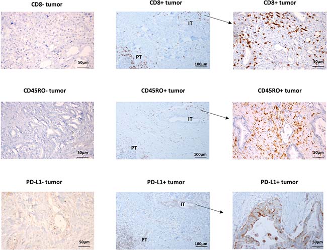 Representative immunohistochemical staining of CD8, CD45RO and PD-L1.
