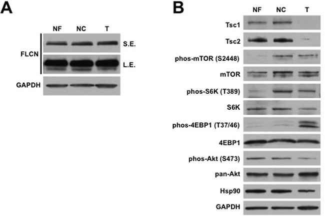 Sporadic renal AML demonstrates somatic loss of Tsc1/2 expression.