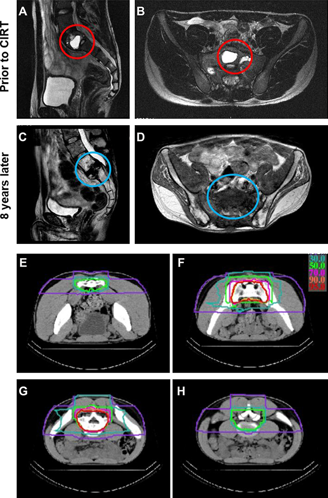 An example of a treated case with unresectable sacral (S1) osteosarcoma.