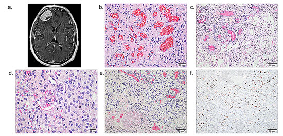 Features of a WHO grade II atypical meningioma with angiomatous features.