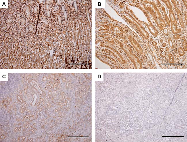 Immunohistochemical analysis for HHLA2 protein expression in primary tumor specimens.