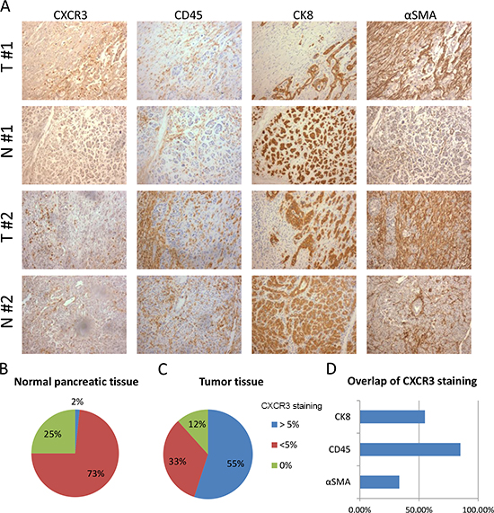 Expression of CXCR3 is elevated in PDAC compared to normal pancreas and is associated with leukocytes infiltration.