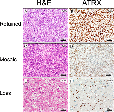 MPNSTs show three distinct patterns of ATRX staining.