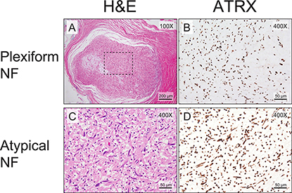 Almost all plexiform neurofibromas show retained ATRX staining pattern.