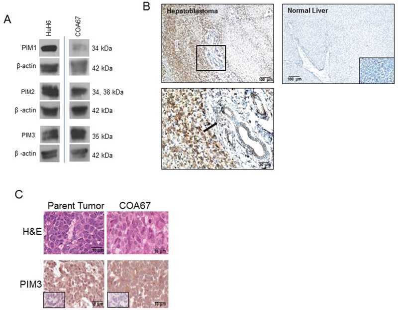 PIM kinases were expressed in HuH6 cells, the COA67 PDX, the parent tumor for COA67, and human hepatoblastoma tumor specimens.