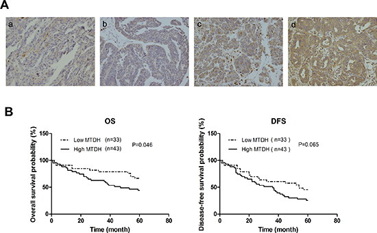 Expression level of MTDH in HGSOC samples correlates with prognosis of patients.