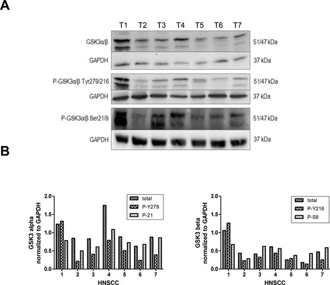 GSK3&#x03B1;/&#x03B2; expression profiles in solid HNSCC.
