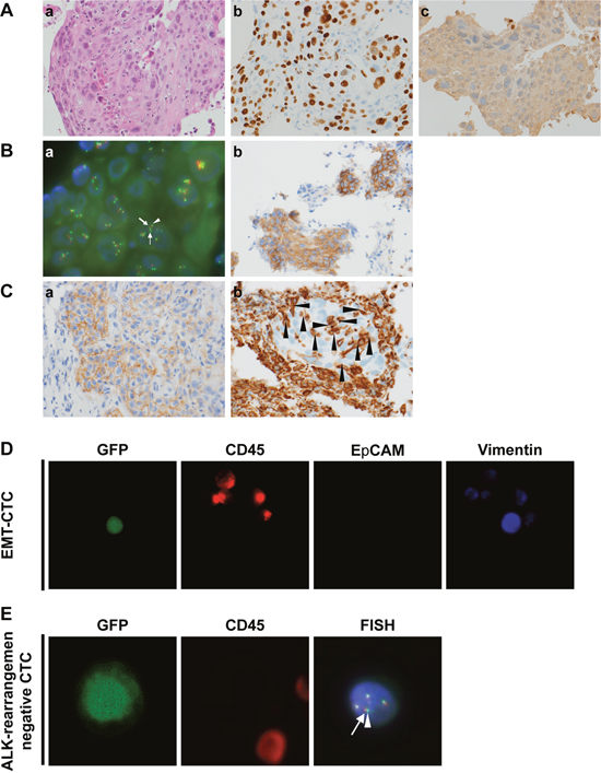 Immunohistological characteristics of case 1, a responder to ALK inhibitors.