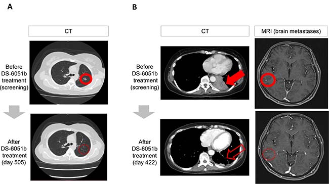 Computed tomography (CT) and magnetic resonance images (MRI) for objective responses.