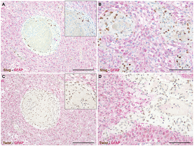 EMT factors are exclusively restricted to vascular proliferations in human astrocytomas.