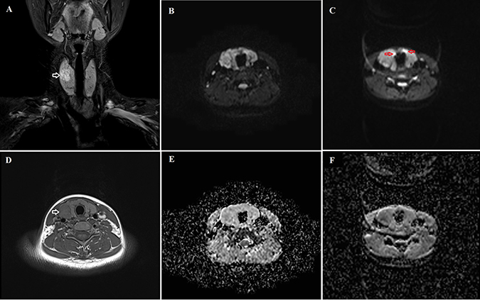 Comparison of the iShim-EPI and 3D-Shim-EPI sequences in a 26-year-old female with a thyroid nodule in the right thyroid lobe.