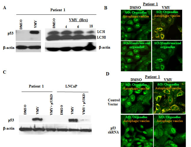 Effects of VMY on prostate cancer conditionally reprogrammed cells (CRCs).