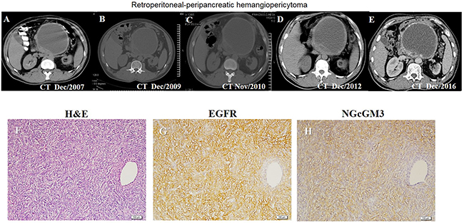 Clinical response to anti-EGFR and anti-NGcGM3 therapy in a patient with retroperitoneal-peripancreatic hemangiopericytoma.