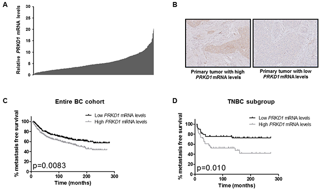 PRKD1 expression is a poor prognostic factor in the entire breast cancer cohort and in the TNBC subgroup.