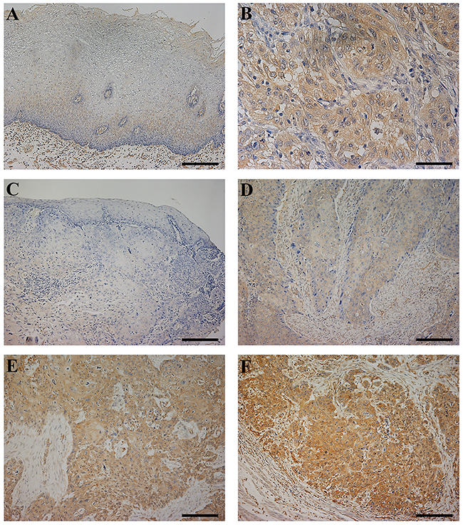 CLIC1 protein expression in human esophageal squamous cell carcinoma (ESCC).