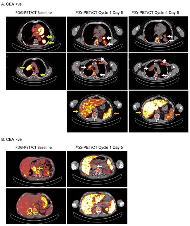 Tumor accumulation in a CEA+ and a CEA&#x2212; patient treated with 20 mg and 30 mg of CEA-IL2v, respectively.