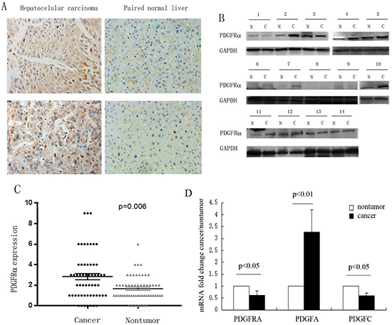 Increased expression of PDGFR&#x03B1; was detected in hepatocellular carcinoma (HCC).