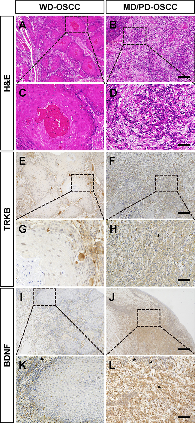 Higher expressions of TRKB and BDNF in moderately or poorly differentiated human OSCC.