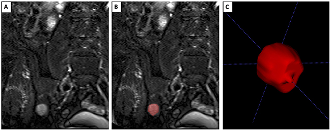 Segmentation of a focal lesion.