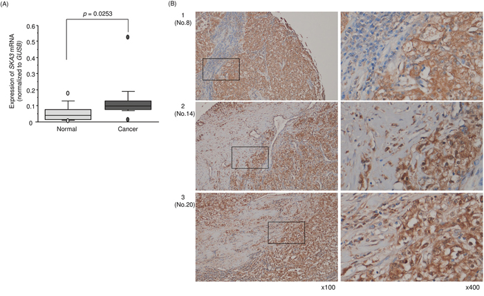 Expression of SKA3 in clinical specimens of RCC.