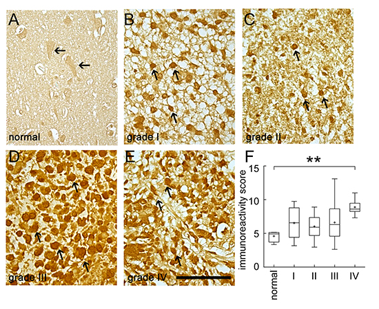 Immunohistochemistry staining for BRCC3 in human brain tumor tissues.