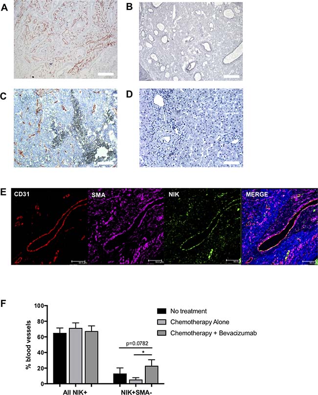 NIK expression in colorectal cancer tissues.
